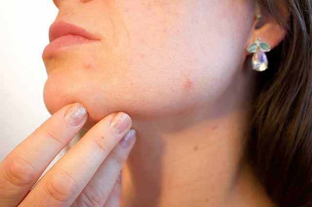 Acne on a woman's skin